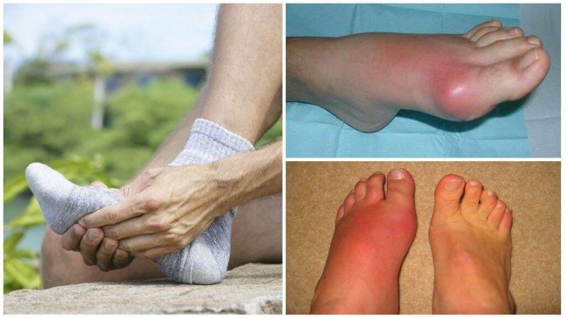 Est-il possible de manger des betteraves pour la goutte: nous analyserons les arguments pour et contre