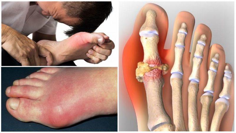 Manger du maïs pour la goutte: est-ce possible ou non, comment le manger pour ne pas nuire à votre santé