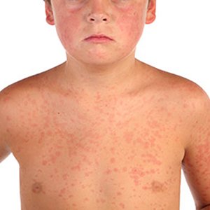 L'allergie au riz est-elle possible et comment se manifeste-t-elle?