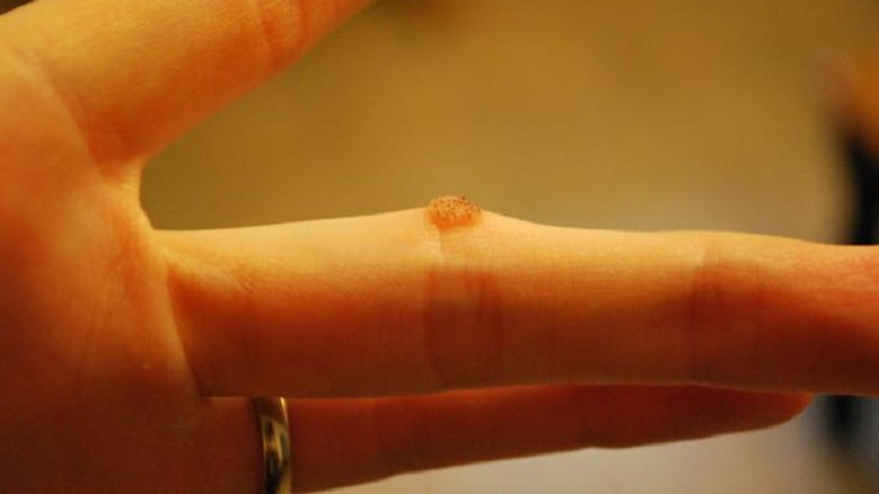 Comment se débarrasser des verrues avec des pommes de terre