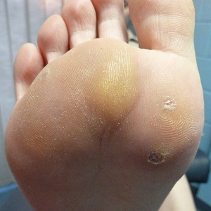 Comment se débarrasser des verrues avec des pommes de terre