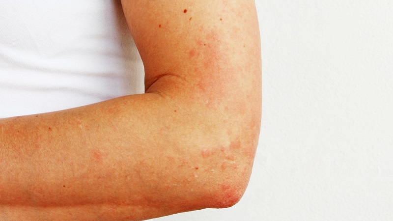 Comment l'allergie aux pommes de terre se manifeste-t-elle chez les enfants et les adultes